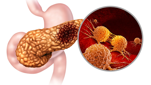 Understanding Rasonque (Daraxonrasib) for Metastatic Pancreatic Cancer